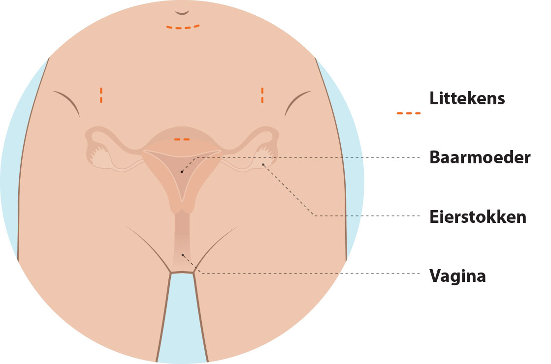 Baarmoeder-kijkoperatie.jpg