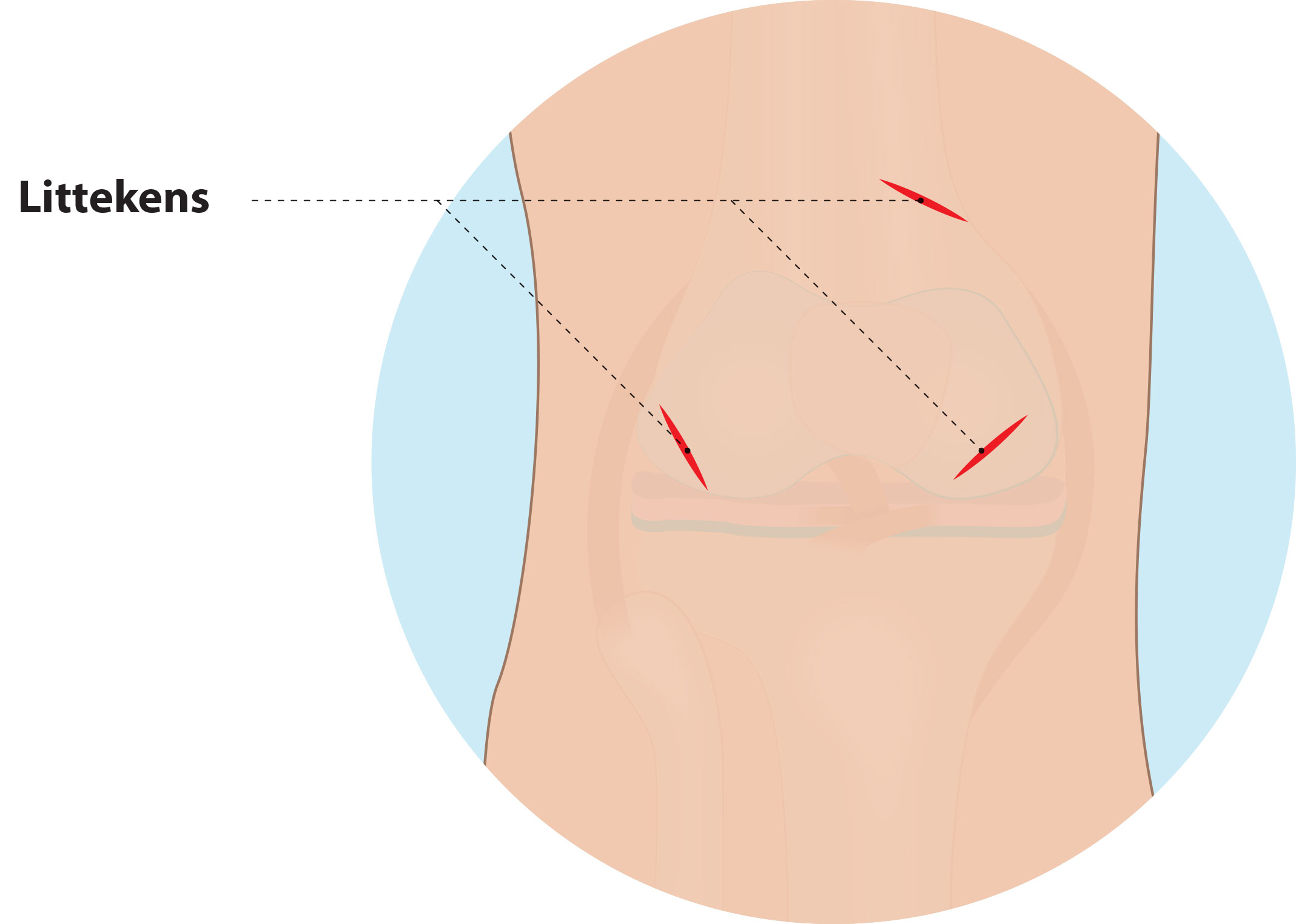 meniscus-4.jpg